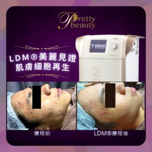 Read more about the article LDM®美麗見證 肌膚細胞再生 LDM®Noblesse